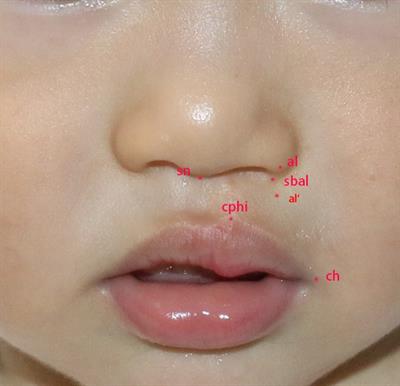 Growth patterns of the nasolabial region following unilateral cleft lip primary repair